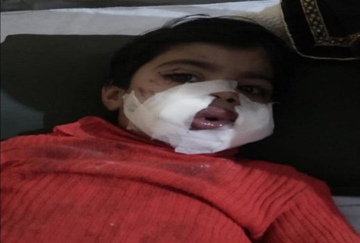 Diwali पर तीन साल की मासूम के मुंह में फोड़ा गया बुलेट बम, हालत गंभीर