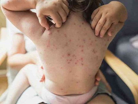भारत में आखिर Chicken Pox को क्यों कहते हैं माता, जानिए ये है बड़ी वजह