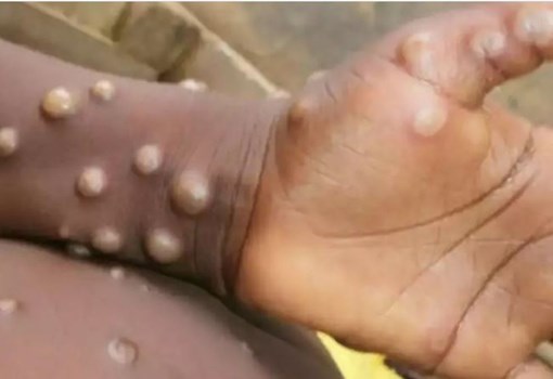  ब्रिटेन पहुंचा Monkeypox Virus, नाइजीरिया से आया था व्यक्ति, जानें इस बीमारी के लक्षण और इलाज