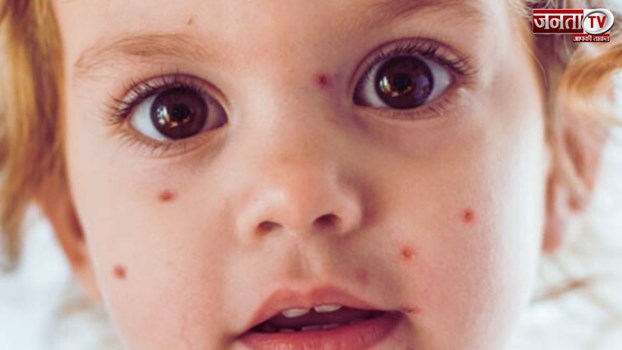 आखिर Chicken Pox को क्यों बुलाते हैं माता. जानें इसके पीछे की वजह