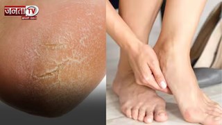 सर्दियों में एड़ियां इतनी क्यों फटती हैं? इन्हें कैसे ठीक रखा जाए, जानिए यहां