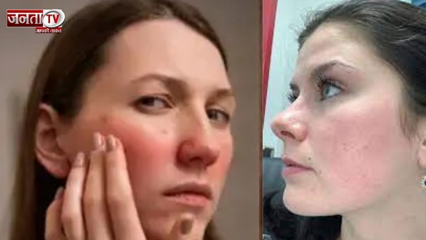 सर्दियों में फट रहे हैं गाल? जानें ये आसान उपाय जो देंगे तुरंत राहत