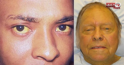 Himachal के इस जिले में पीलिया का प्रकोप...13 स्कूली बच्चों समेत 35 लोग चपेट में आए