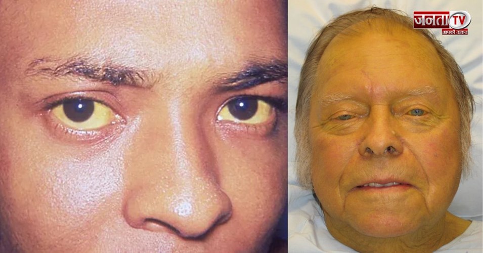 Himachal के इस जिले में पीलिया का प्रकोप...13 स्कूली बच्चों समेत 35 लोग चपेट में आए