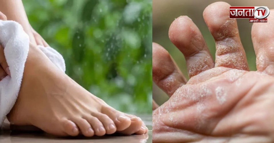मानसून में पैरों को रखें फंगल इंफेक्शन से सुरक्षित, ये गलतियां पड़ सकती हैं भारी